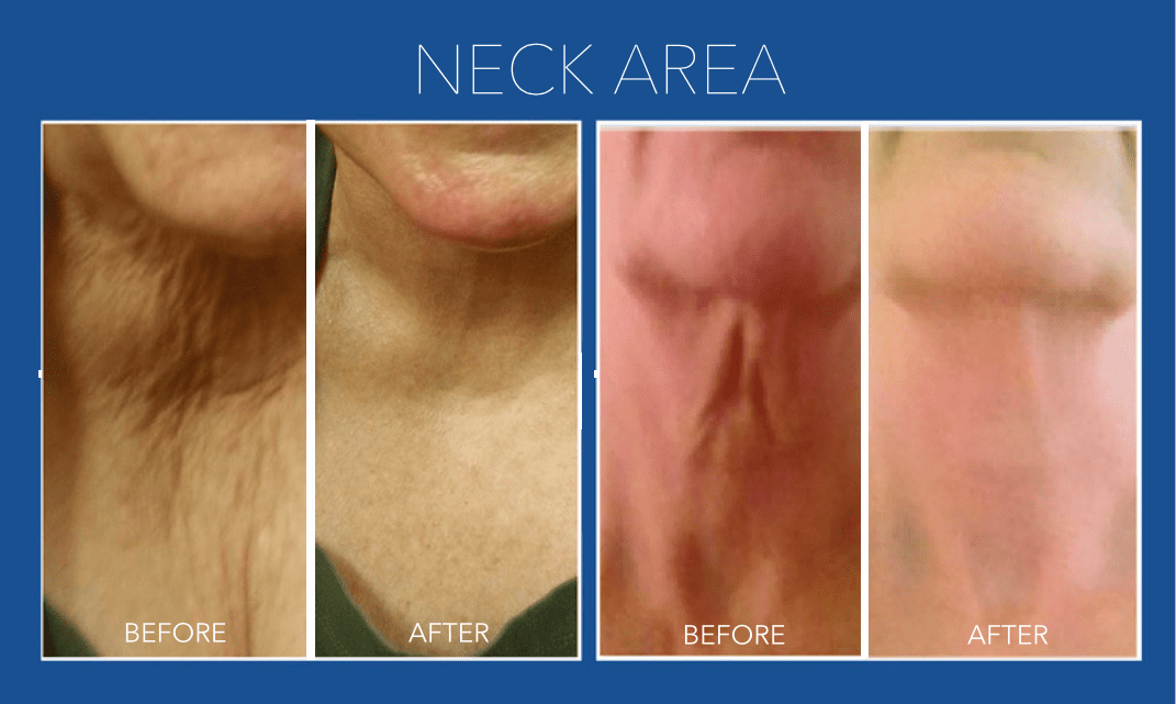Rejuvapen Before and After Neck Area