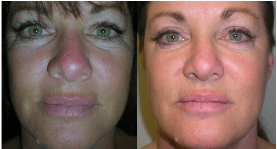 Before and One Month Following 6th Treatment of DermaSweep