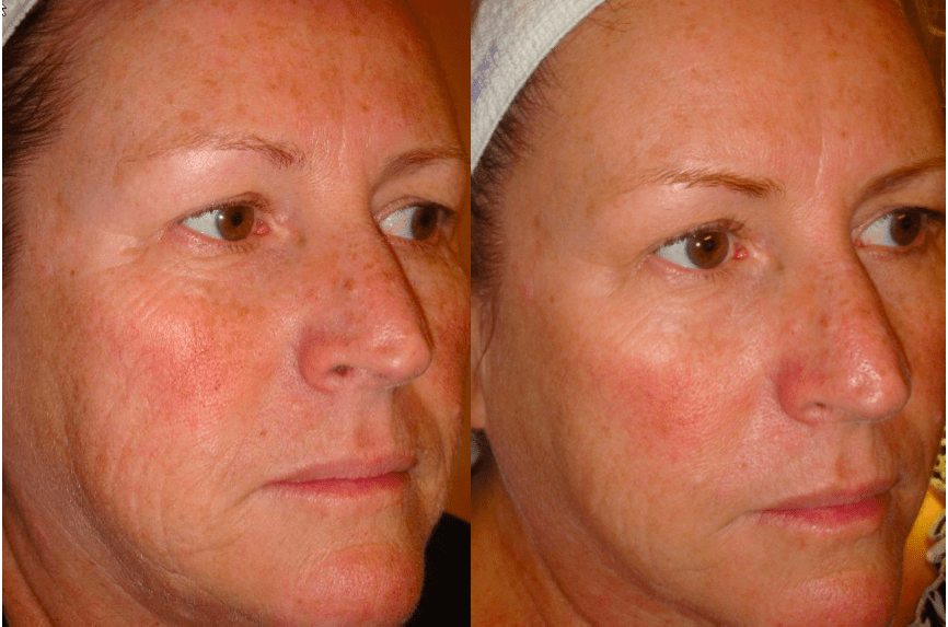 Before and One Month After 6th Treatment of the DermaSweep
