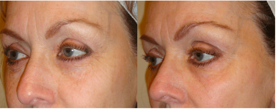 Before and 6 Weeks Following 4th Treatment of DermaPlus Peel