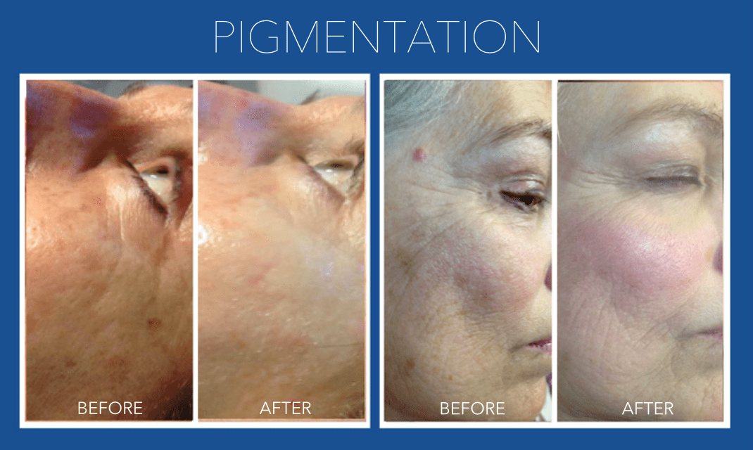 Rejuvapen Before and After Pigmentation
