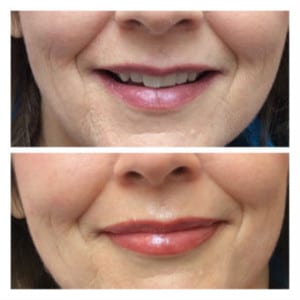 Semi-permanent lips before & after photo